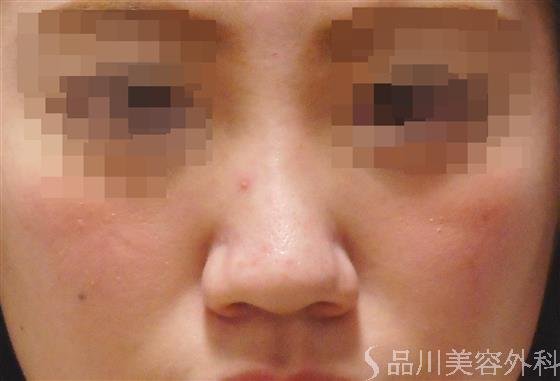 症例NO.34069のBEFORE写真