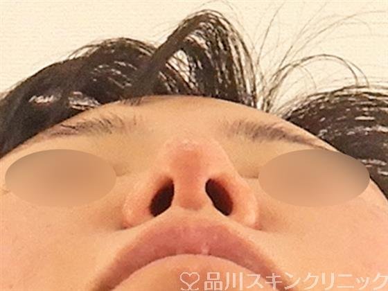 症例NO.58726のBEFORE写真