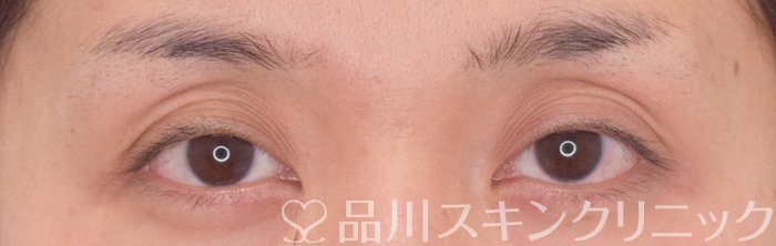 症例NO.64261のBEFORE写真