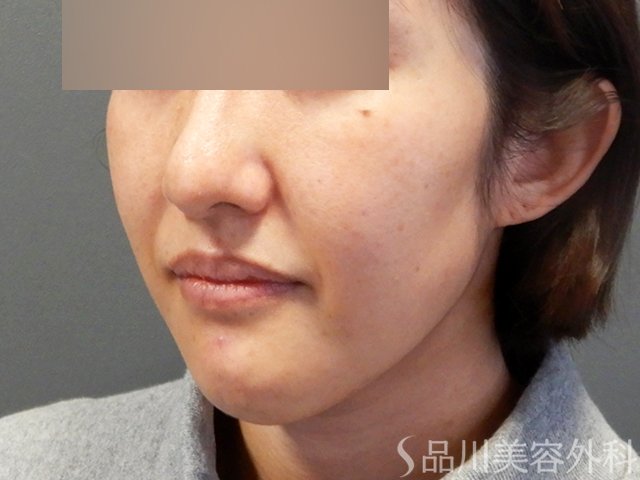 症例NO.69181のBEFORE写真