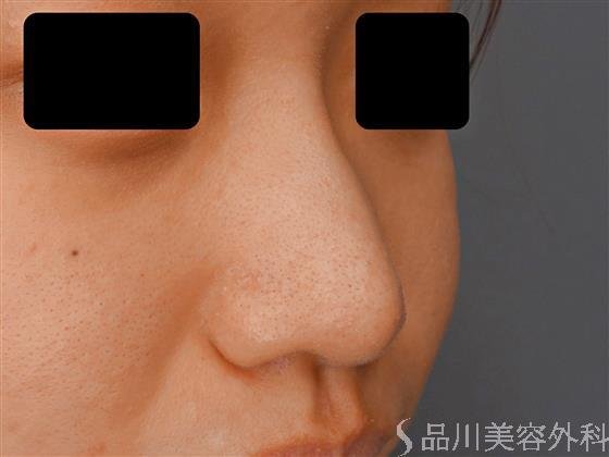 症例NO.58280のBEFORE写真