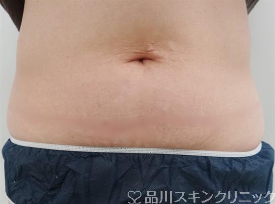 症例NO.35811のBEFORE写真