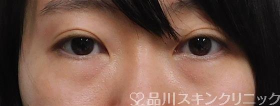 症例NO.49174のBEFORE写真