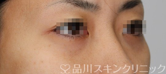 症例NO.64805のAFTER写真