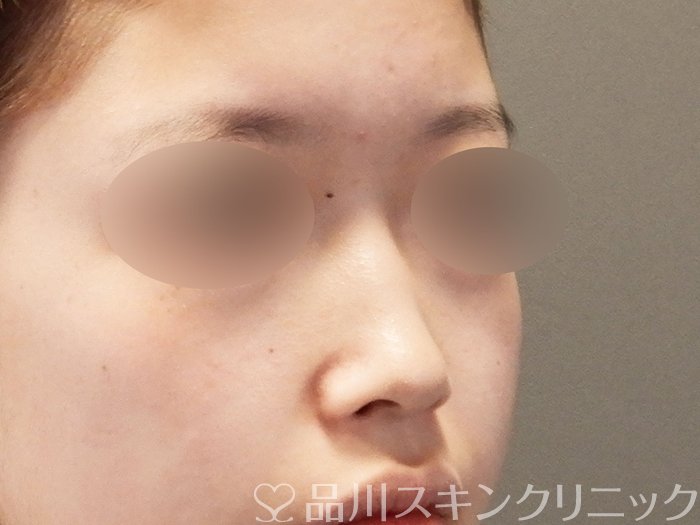 症例NO.64916のBEFORE写真