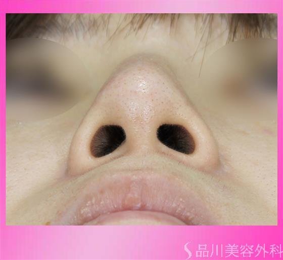 症例NO.51928のBEFORE写真