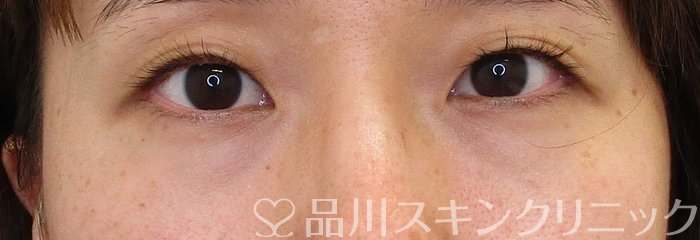 症例NO.63446のBEFORE写真