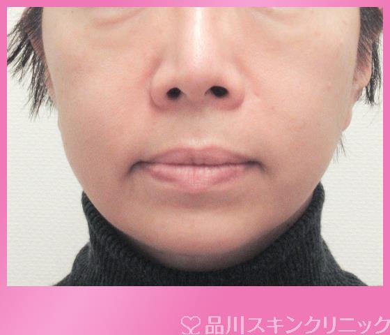 症例NO.27063のBEFORE写真