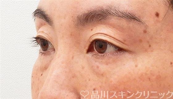 症例NO.61489のBEFORE写真