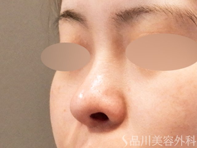 症例NO.65963のBEFORE写真