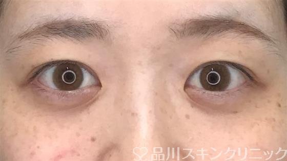 症例NO.57179のBEFORE写真