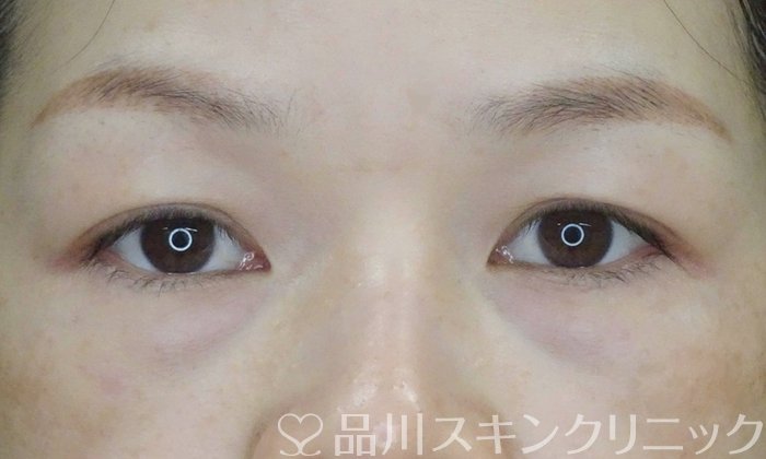 症例NO.62307のBEFORE写真