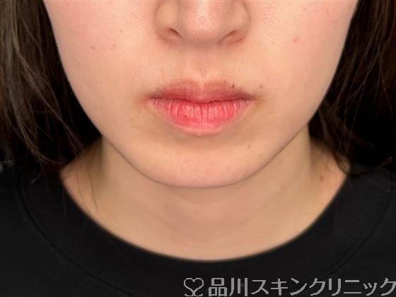 症例NO.59984のBEFORE写真