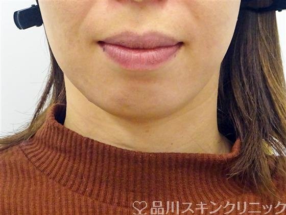 症例NO.45409のBEFORE写真