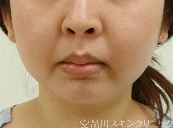 症例NO.40087のBEFORE写真