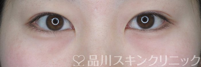 症例NO.64373のBEFORE写真