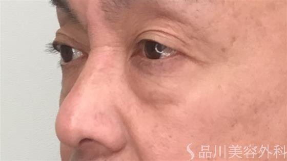 症例NO.54246のBEFORE写真