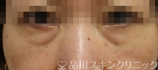 症例NO.65560のBEFORE写真