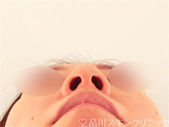 症例NO.57689のBEFORE写真