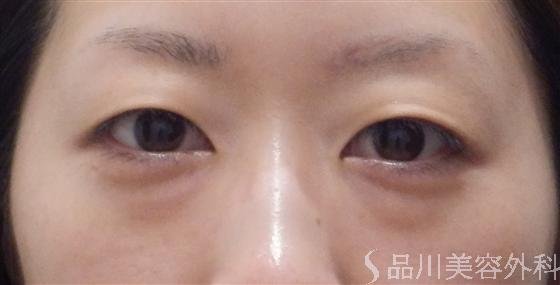 症例NO.15850のBEFORE写真