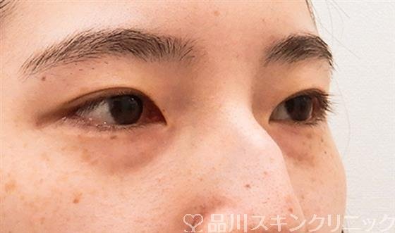 症例NO.61040のBEFORE写真