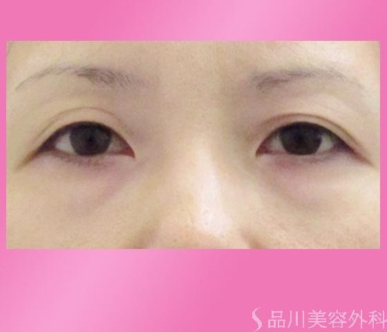 症例NO.1597のBEFORE写真