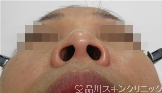 症例NO.53272のBEFORE写真