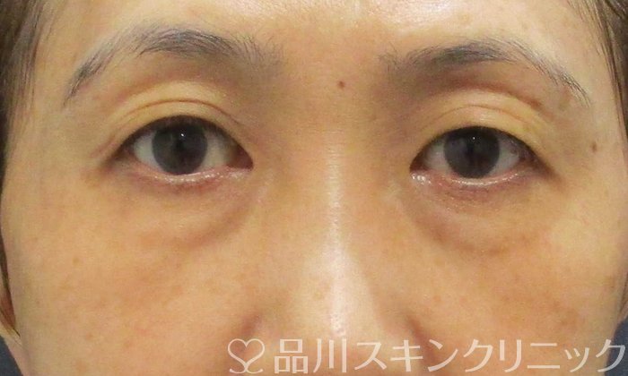 症例NO.67440のBEFORE写真