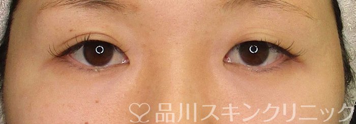 症例NO.69091のBEFORE写真