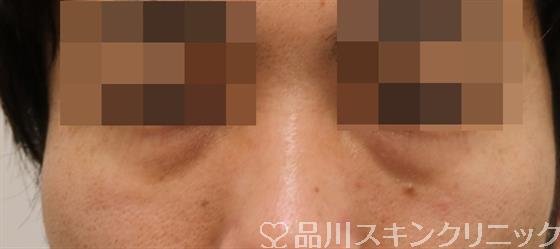 症例NO.43042のBEFORE写真