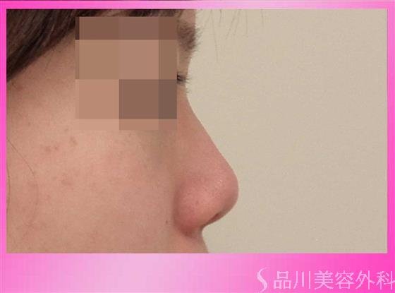 症例NO.32168のBEFORE写真