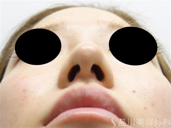 症例NO.28757のBEFORE写真