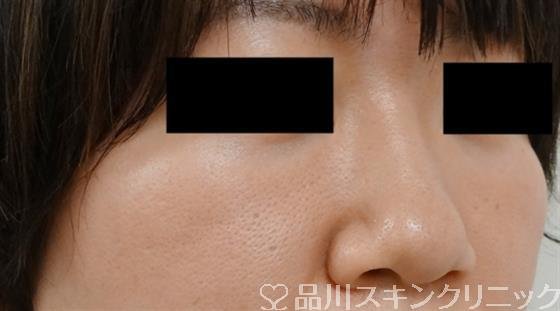 症例NO.40090のBEFORE写真