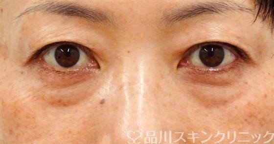 症例NO.51706のBEFORE写真