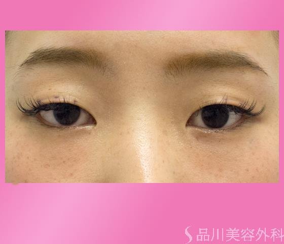 症例NO.22996のBEFORE写真