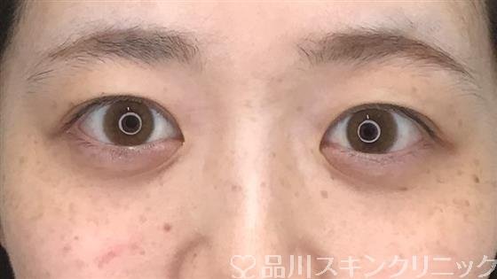 症例NO.56408のBEFORE写真