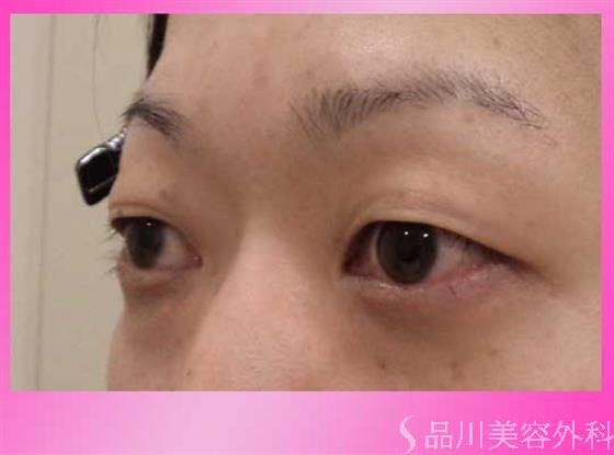 症例NO.44989のBEFORE写真