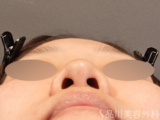 症例NO.66103のBEFORE写真