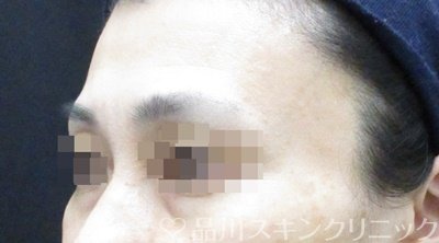 症例NO.66070のBEFORE写真