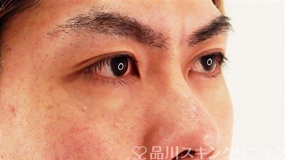 症例NO.58974のBEFORE写真