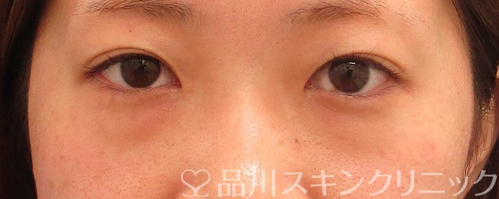 症例NO.62989のBEFORE写真