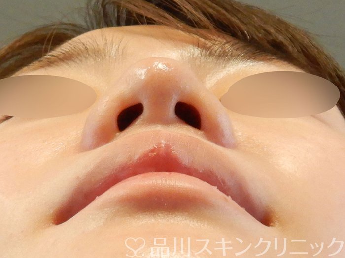 症例NO.63136のBEFORE写真