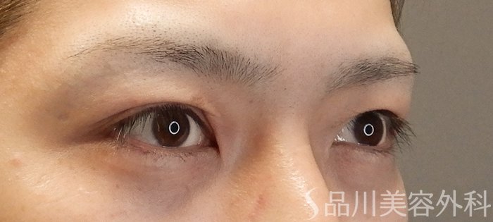 症例NO.67165のBEFORE写真