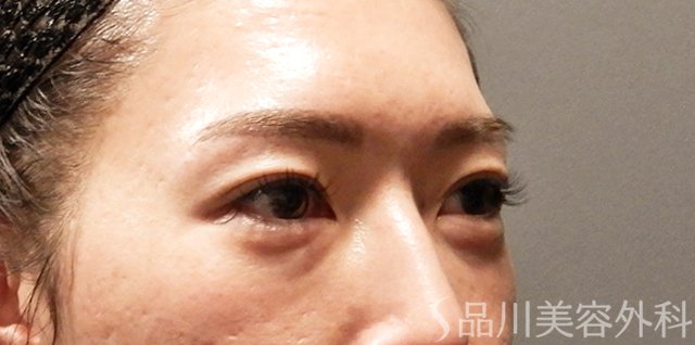 症例NO.63470のBEFORE写真