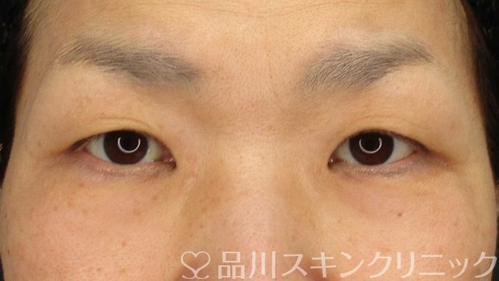 症例NO.66227のBEFORE写真