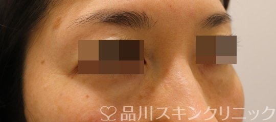 症例NO.68692のBEFORE写真