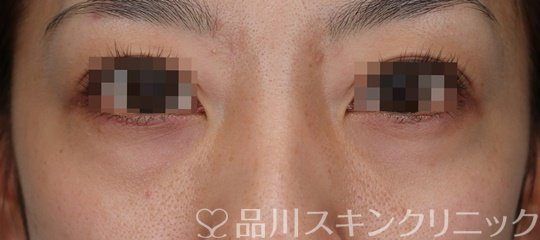 症例NO.64759のBEFORE写真