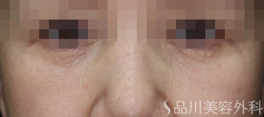 症例NO.66961のBEFORE写真