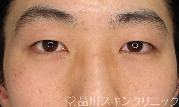 症例NO.68383のBEFORE写真