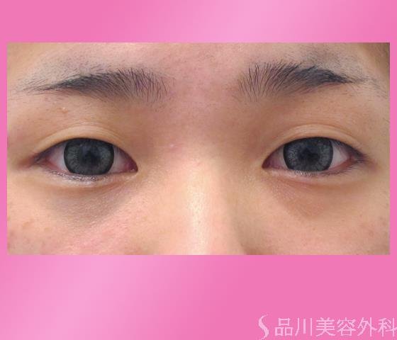 症例NO.25784のBEFORE写真